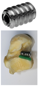 Subtalar Arthroereisis