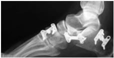 Osteotomy