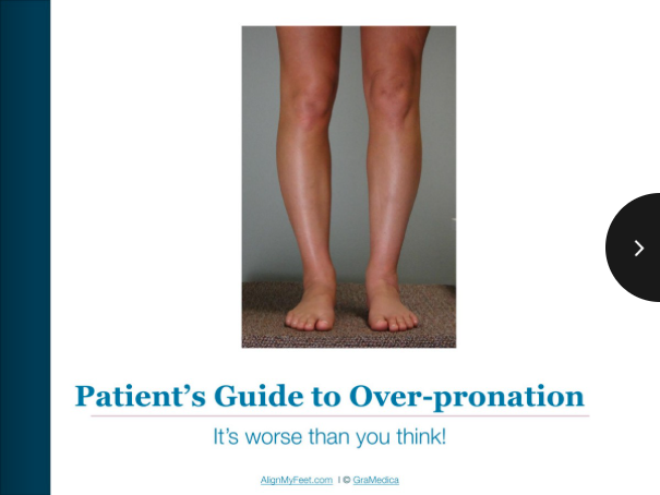 extreme overpronation