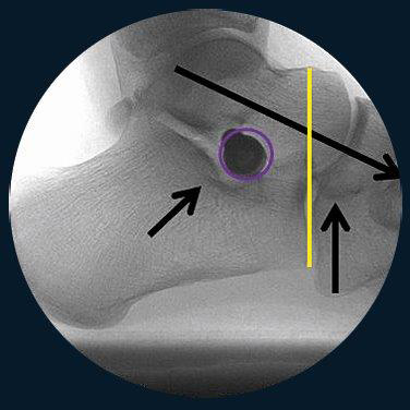 Hyperpronation