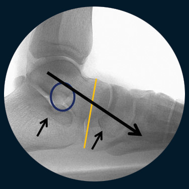 Hyperpronation