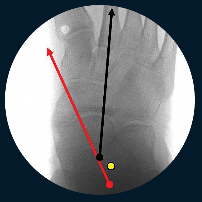 Hyperpronation