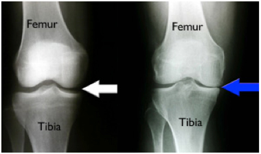 Hyperpronation